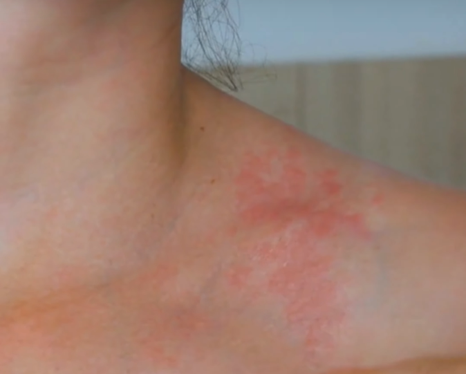 Ilustracija razlike između intolerancije i alergije na mleko