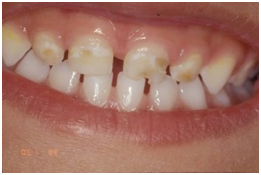 Cirkularni karijes kod dece