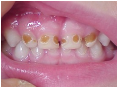 Cirkularni karijes kod dece