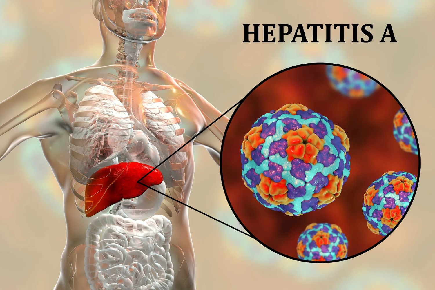 Hepatitis A