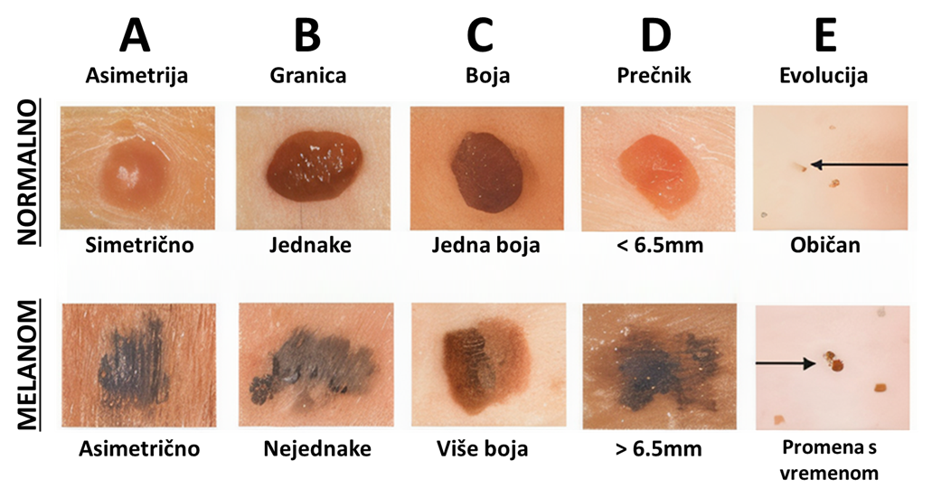 Infografika ABCDE pravila za prepoznavanje melanoma