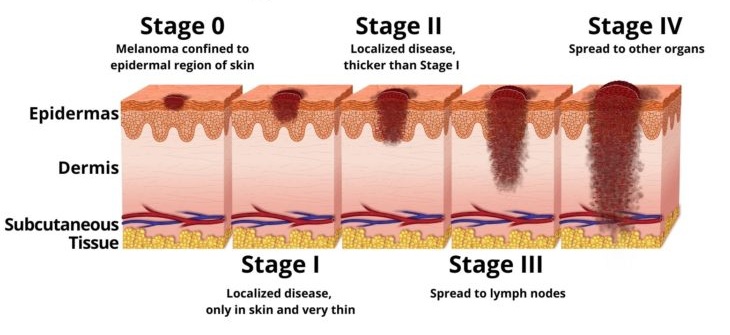 melanom faze razvoja