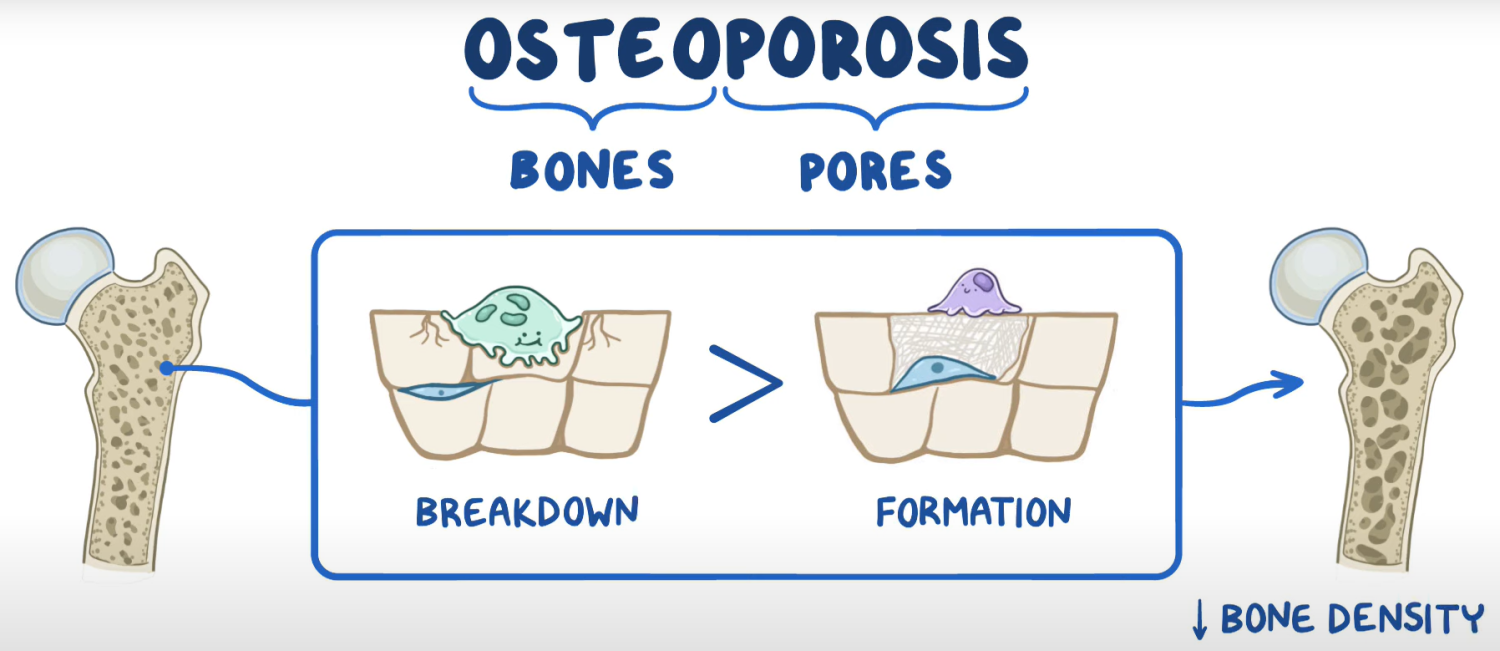 Definicija reči osteoporoza i ilustracija osteoporotične kosti