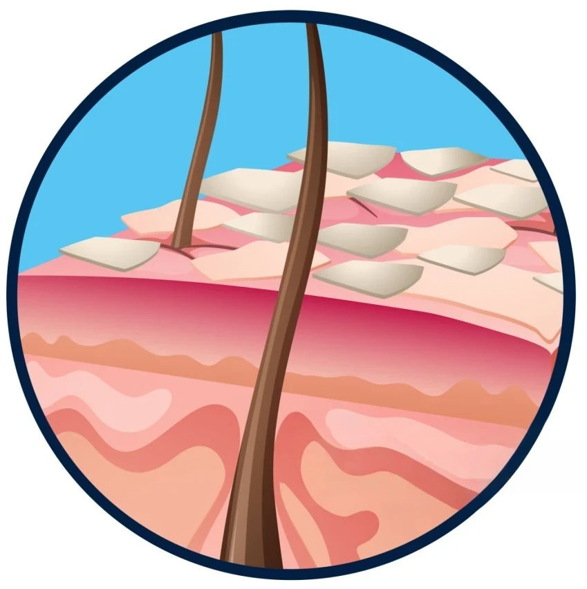 Psorijaza: Uzroci i simptomi