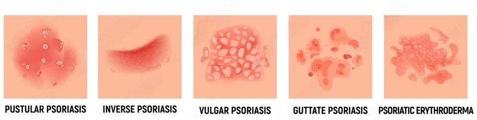 Različiti tipovi psorijaze
